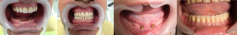 Ενδοστοματικές εικόνες ασθενών με 2 εμφυτεύματα στην κάτω γνάθο, πάνω στα οποία “κουμπώνουν” οι οδοντοστοιχίες.