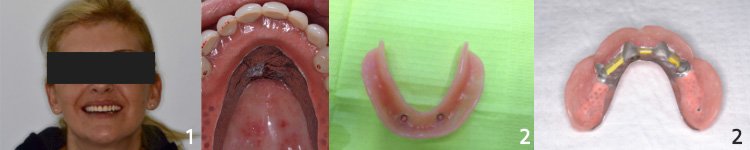 1) Ενδοστοματική εικόνα ασθενούς με 4 εμφυτεύματα στην άνω γνάθο, πάνω στα οποία “κουμπώνει” η οδοντοστοιχία η οποία αφήνει ελεύθερο τον ουρανίσκο. 2) Εικόνες των πάνω και κάτω επένθετων οδοντοστοιχιών όπως φαίνονται κατά την αφαίρεσή τους από το στόμα. Παρατηρούμε τις υποδοχές πάνω στις οποίες “κουμπώνουν” τα εμφυτεύματα στις οδοντοστοιχίες μας.